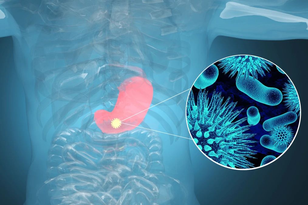 肿瘤标记物CA72-4：“胃”，你还好吗？